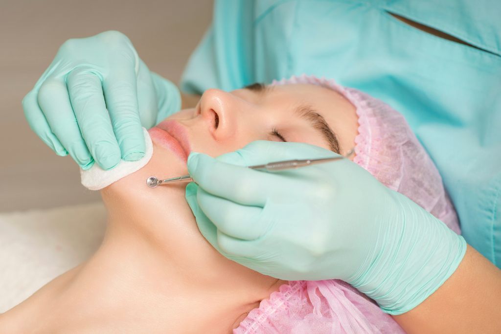 tratamiento acne